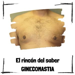 Ginecomastia - El rincón del saber